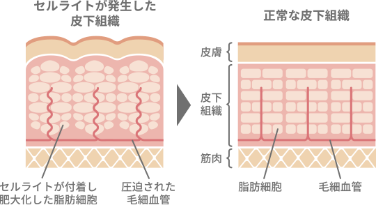 HIFU効果図